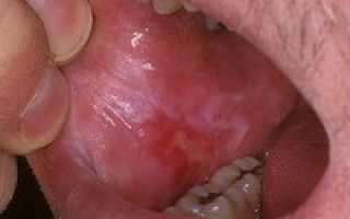 Причины возникновения ожога слизистой рта — лечение в домашних условиях