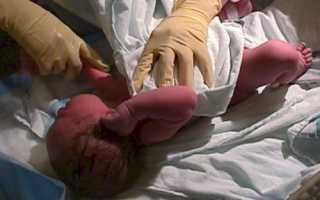 Опасна или нет гематом на голове у новорожденного