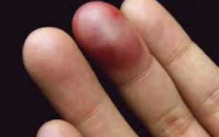 Ушиб пальца причины, симптомы, методы лечения и профилактики